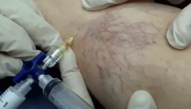 skleroterapia na kŕčové žily