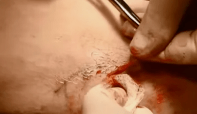 typy operácií na odstránenie kŕčových žíl